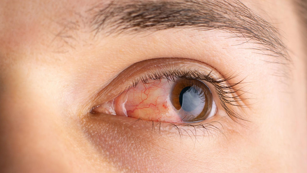 Glaucoma Management